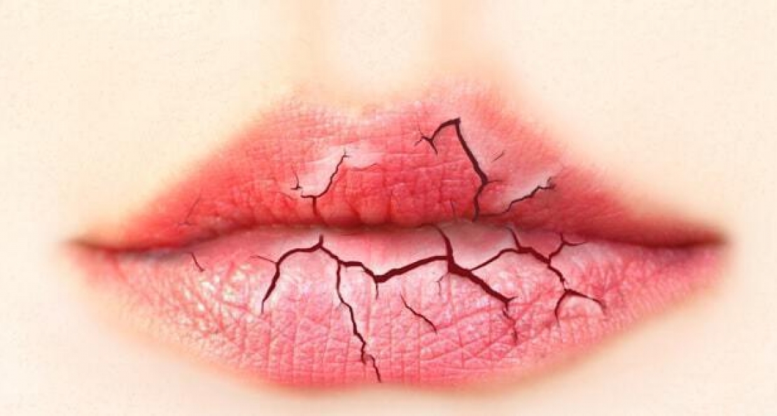 Σκασμένα / Αφυδατωμένα χείλη το χειμώνα