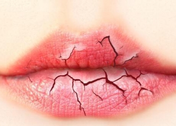 Σκασμένα / Αφυδατωμένα χείλη το χειμώνα